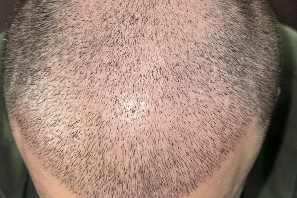 Saç Ekimi - Hair Transplant