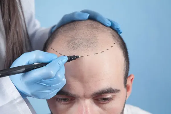 İstanbul Saç Ekim Merkezi - Mt Hair Clinic