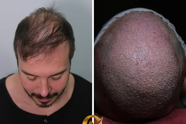 AVRUPA SAÇ EKİMİ - AVRUPA HAİR TRANSPLANT.|Greffe de Cheveux Turquie | Trasplante Capilar Turquia | Пересадка Волос в Турции