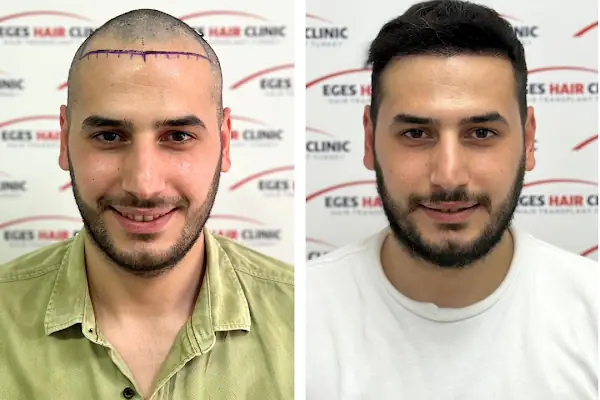 Bayraklı Saç Ekim Merkezi - İzmir Eges Hair Transplant