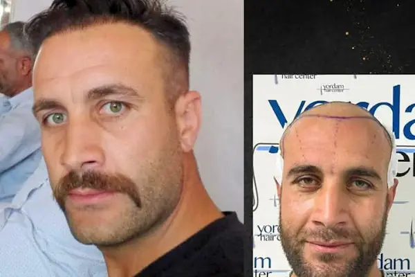 yordam hair saç ekim