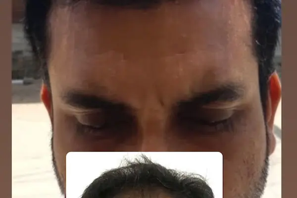 İzmir Saç Ekimi | İzmir Hair Transplantation | Serena Polikliniği | İzmir Kaş Ekimi